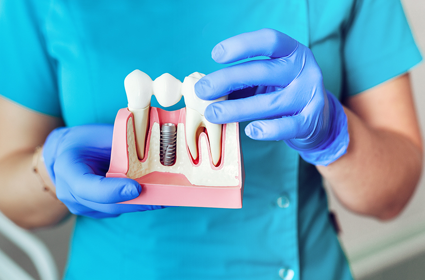 Implantes Dentários